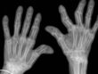 Rheumatoid Arthritis
