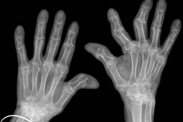 Rheumatoid Arthritis