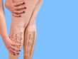 Varicose Veins