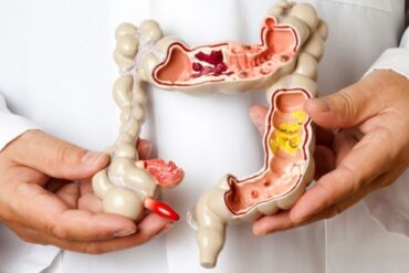    Naturopathic Approaches to Alleviating PMS