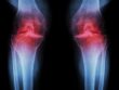 Osteoarthritis