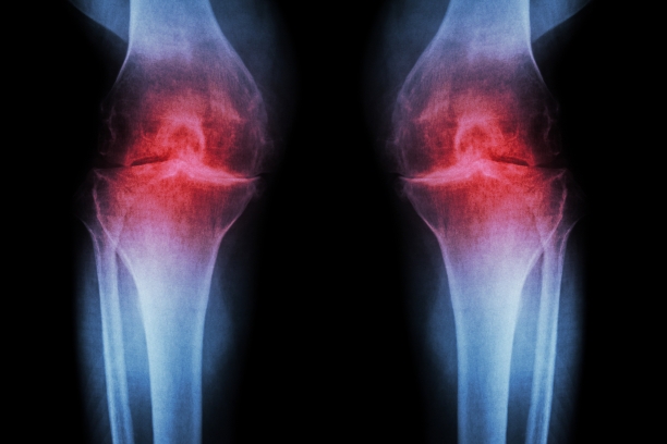 Osteoarthritis