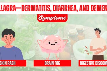 Understanding Food Intolerance: Signs, Symptoms, and Management