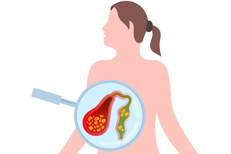 Learn about gallstones, their symptoms, causes, diagnosis, and treatment options. Discover prevention tips and effective management strategies for gallstone relief.