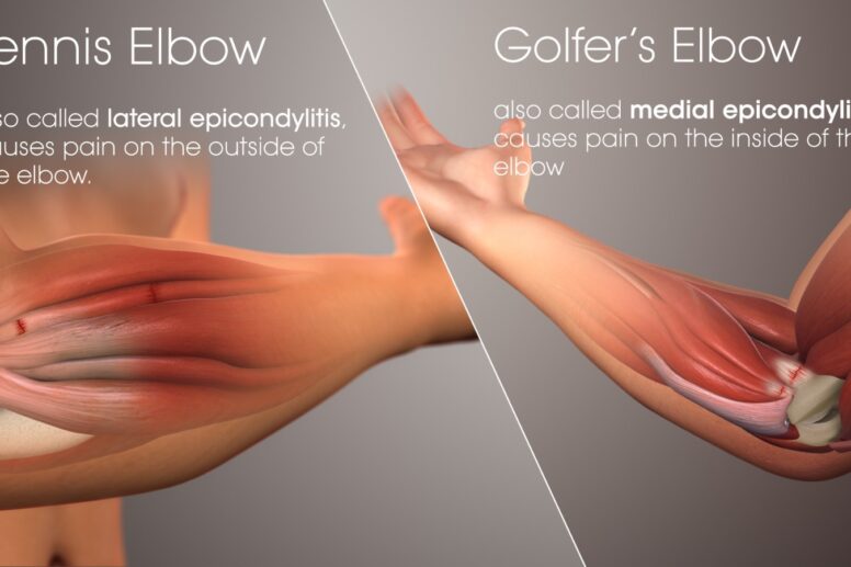 Tennis and Golfer's Elbow: Symptoms, Naturopathic and Conventional Management